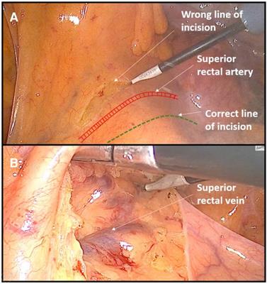 Is non-mentored initiation of laparoscopic colorectal surgery safe? Single surgeon initial experience with the first 40 cases